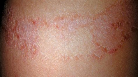 Skin Rash Pictures Causes Types And Treatments
