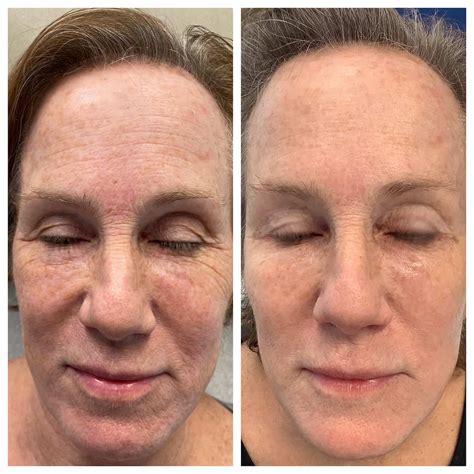 Comprehensive Facial Rejuvenation Before And After St Louis Dermatology Cosmetic Surgery