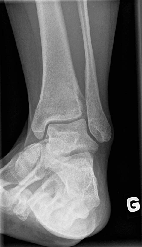 Osteoid Osteoma Of The Distal Tibia Image