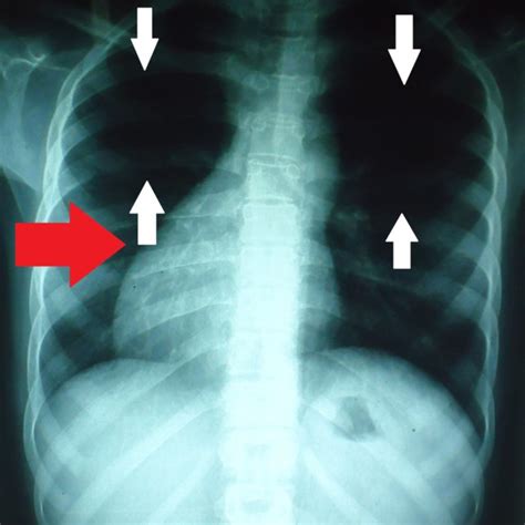 Posteroanterior Chest X Ray Pa Showing Oligemic Lung Fields See White