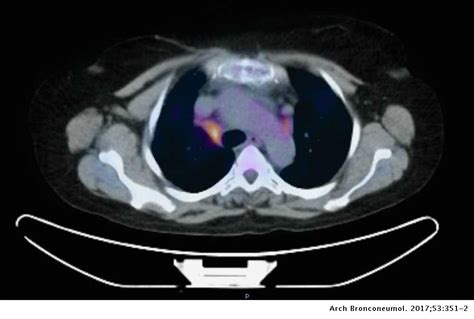 Diagnosis Of Actinomyces Graevenitzii Lung Infection Using Linear Ebus