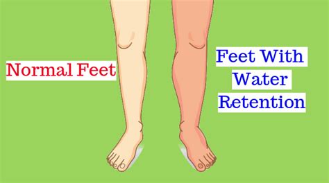 Water retention, also known as fluid retention or oedema, occurs when excess fluids build up inside the body.﻿ ﻿water retention can lead swelling in the hands, feet, ankles we earn a commission for products purchased through some links in this article. Best ways to cure water retention naturally