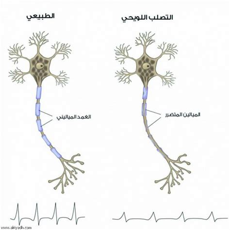 اسباب التصلب المتعدد اللويحي : جريدة الرياض | التصلب اللويحي.. كلما كان التشخيص مبكراً ...