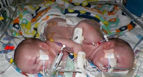 Miracle 26 Hour Surgery To Separate Conjoined Twin Girls To Be Aired On Nightline