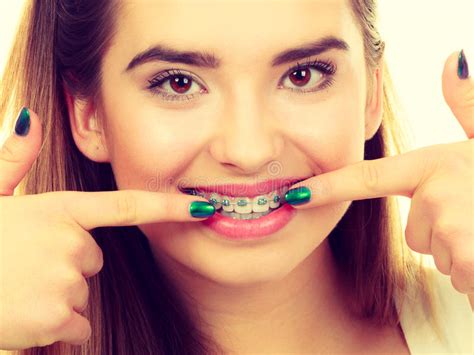 Woman Showing Her Teeth With Braces Stock Image Image Of Metal Lips