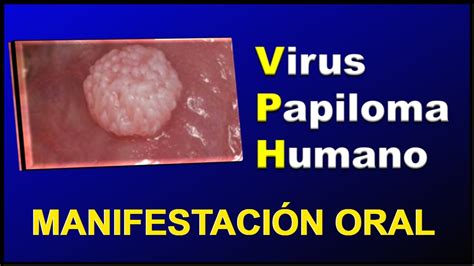Manifestaciones Orales 𝐃𝐄𝐋 Virus 𝐃𝐄𝐋 Papiloma Humano Vph Youtube