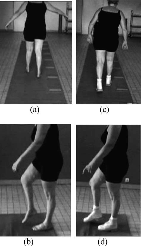 Orthopaedic Shoes Improve Gait In A Charcot Marie Tooth Pati