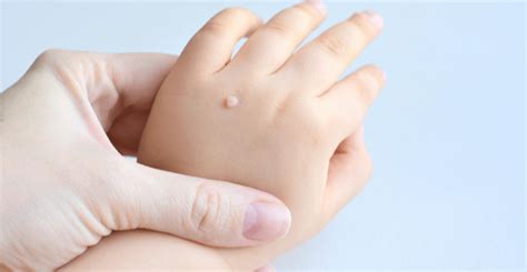 What Causes Warts Dermatology And Skincare Associates