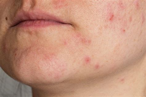 What You Need To Know About Adult Acne And 6 Ways To Treat It