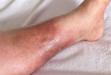 Skin Infections 101 Erysipelas Vs Cellulitis