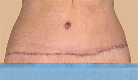 Tummy Tuck Scar Healing Treatment And Revision