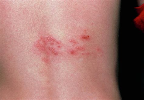 Rash Of Shingles Herpes Zoster On Lower Back Photograph By Dr P