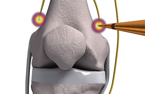 Genicular Nerve Radio Frequency Ablation Procedure And Recovery