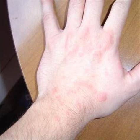 How To Treat Hives With Benadryl Healthy Living