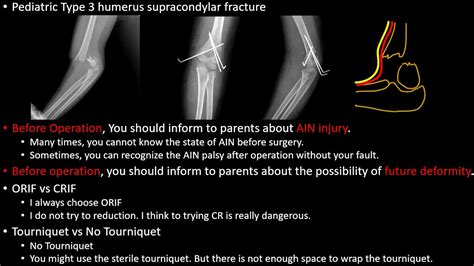 Pediatric Humerus Type 3 Supracondylar Fracture Youtube