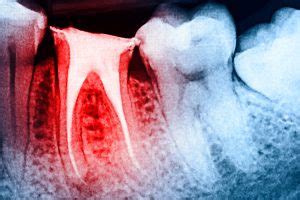 We did not find results for: Can I Still Have Pain After a Root Canal? | Creekside ...