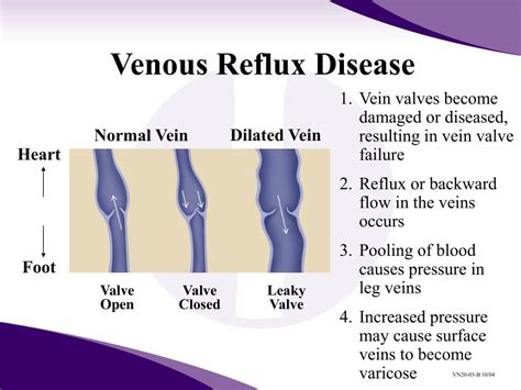 Ppt Venous Reflux Disease And Current Treatment Modalities Powerpoint