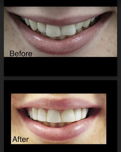 5 Before And After Invisalign Transformations Tooth Doctor