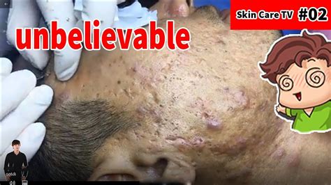 Blackheads Cystic Acne And Pimples Extraction Acne Treatment On Face 2 Skin Care Tv Youtube