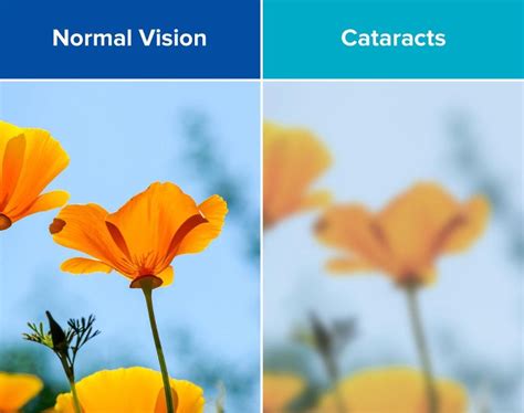 Cataracts Causes Symptoms And Treatment Acuity Eye Group