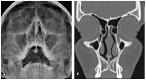 Nasal Septum Anatomy And Deviations Beyond Straight And Flat Semantic Scholar
