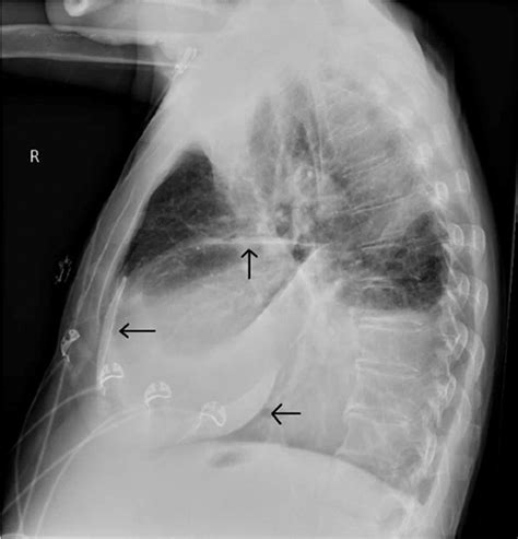 Use Of Chest X‐ray For Early Differentiation Between Constrictive And