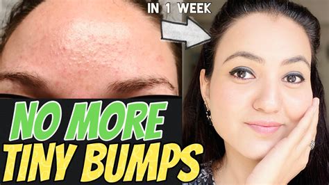 1 Week Challenge 💕 Get Rid Of Tiny Bumps Naturally In Just 7 Days And