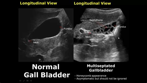 Diseased Gallbladder Ultrasound