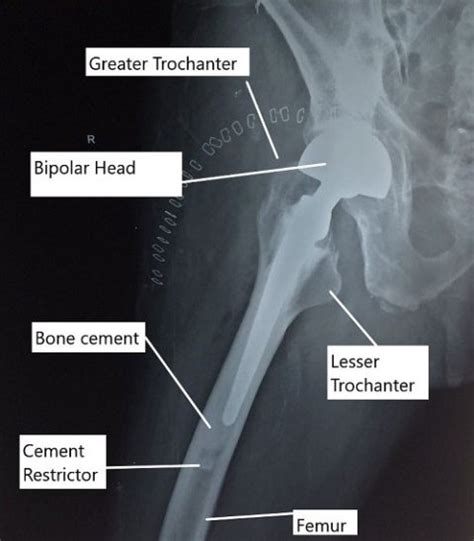 Uncemented Vs Cemented Hip Replacement Complete Orthopedics