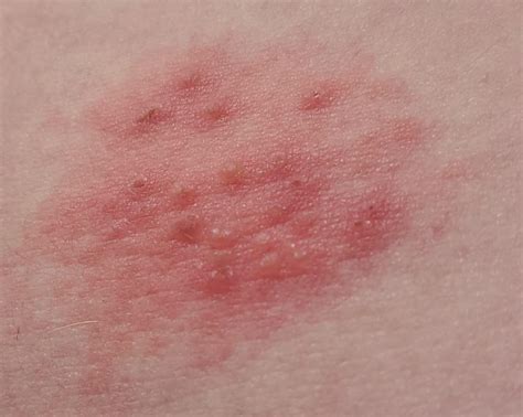 Shingles Skin Bumps Itchy Bumps Itchy Red Bumps The Best Porn Website