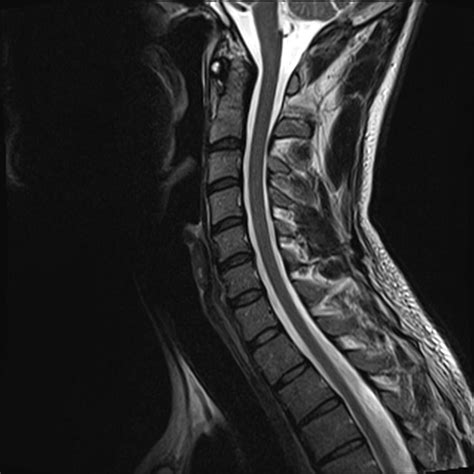 Normal Cervical Spine MRI Image Radiopaedia Org
