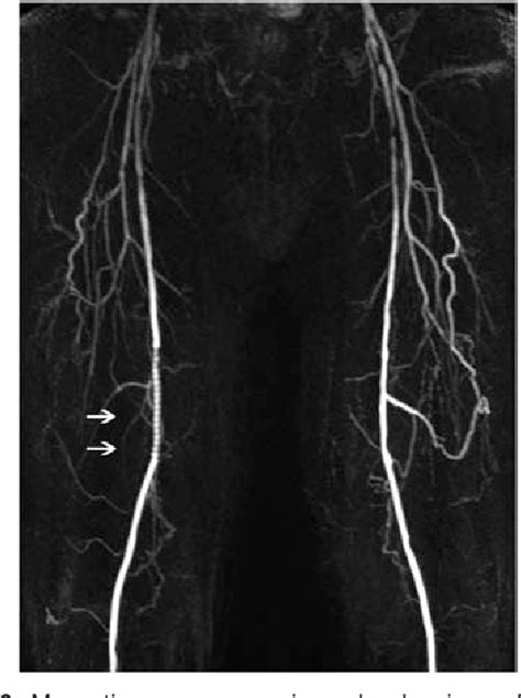 Figure 6 From Multimodality Imaging Of Lower Extremity Peripheral