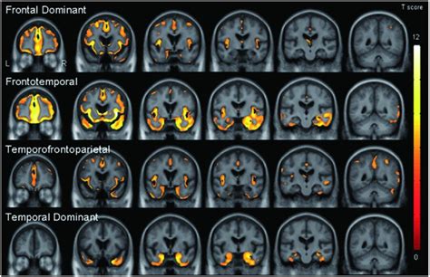 Imaging of frontotemporal dementia | Neupsy Key