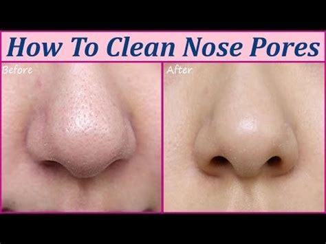 Clearing blocked pores one of the most effective and safest ways to unclog pores is to use b. 7 Unclogging Pore Treatments That Will Change Your Life ...