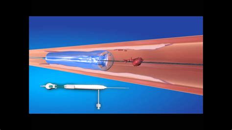 Proteus Embolic Capture Angioplasty By Angioslide Youtube