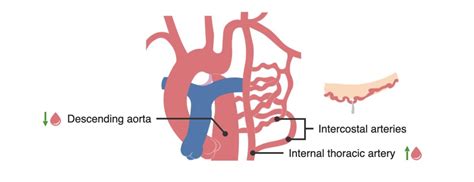 Coarctation Of The Aorta Concise Medical Knowledge