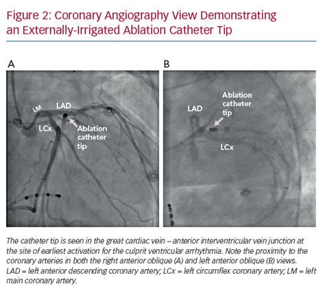 Coronary Angiography View Demonstrating An Externally Irrigated