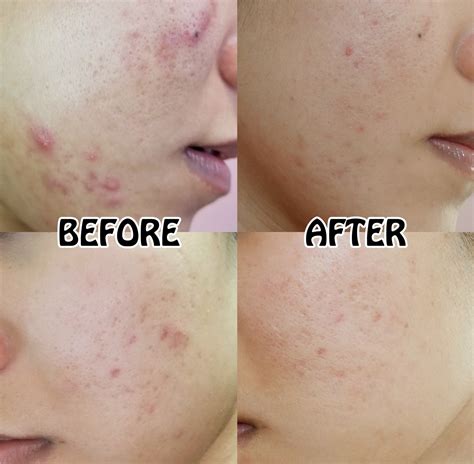 Curology Review How I Get Rid Of Acne In 2 Months Joliecious