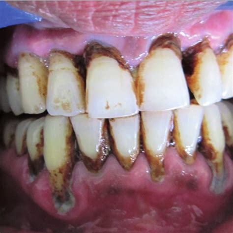 4 effects of tobacco smoking on periodontal health and disease download scientific diagram