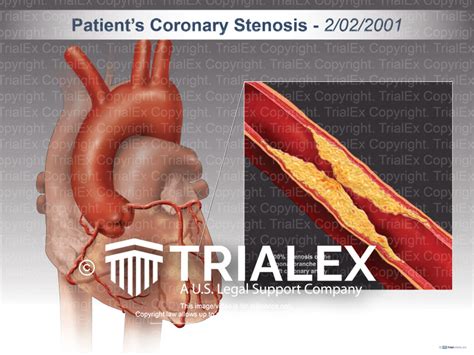 Coronary Stenosis Trialexhibits Inc
