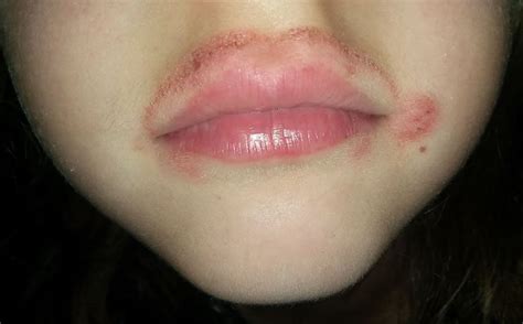 Skin Rash Around Lips Lipstutorial Org