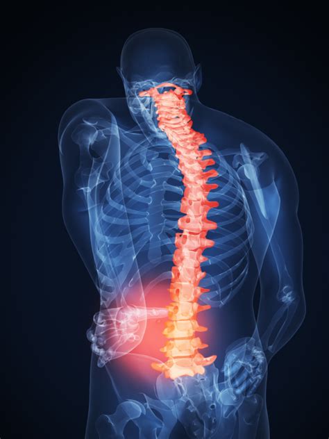 Disc Injuries Spinecare Chiropractic Adelaide Chiropractors