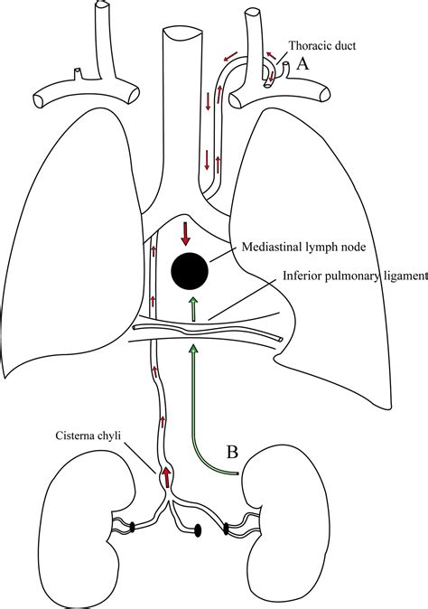 Frontiers Solitary Metastasis In The Mediastinal Lymph Node After