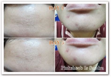 改善肌膚底層暗粒問題。 Dermaquest Modified Jessners Peel 百滙皮膚中心 護膚 Seewide