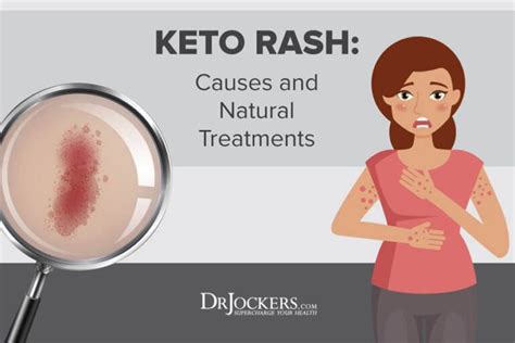 Keto Rash Causes And Natural Treatments Keto Rash Natural