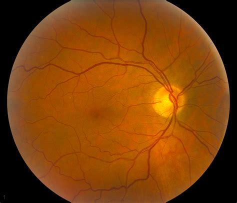 Vitamin A Deficiency And Nyctalopia Ophthalmology