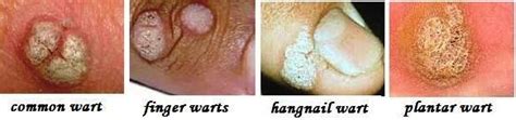 Contagious, on fingers, home remedies, on foot. About Wart Removal And Treatment: Facts About Warts That ...