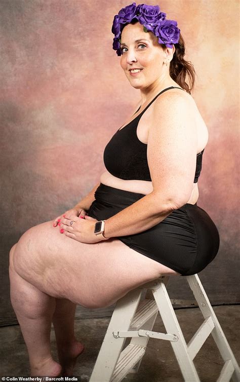 Woman 44 Who Has Abnormal Fat Build Up On Thighs Says Social Media