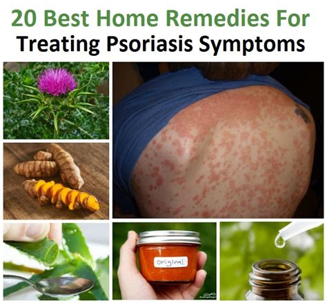 Genital Herpes Cure Research 2012 Natural Cures For Psoriasis