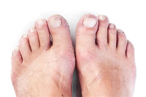 Athletes Foot Foot And Ankle Centers Of Frisco And Plano
